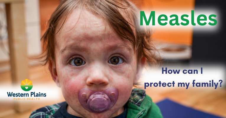 Measles 3.2025